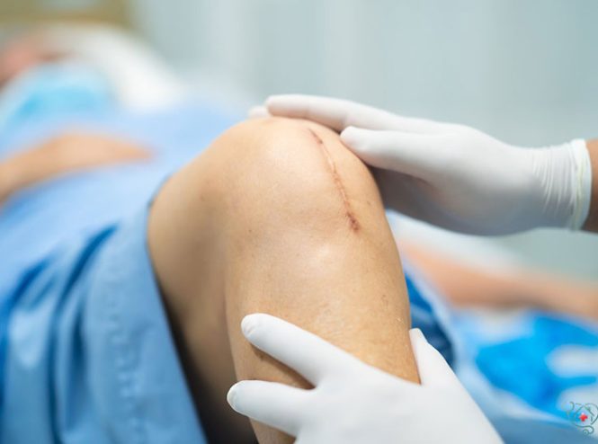 بعد از کشیدن بخیه چه باید کرد؟