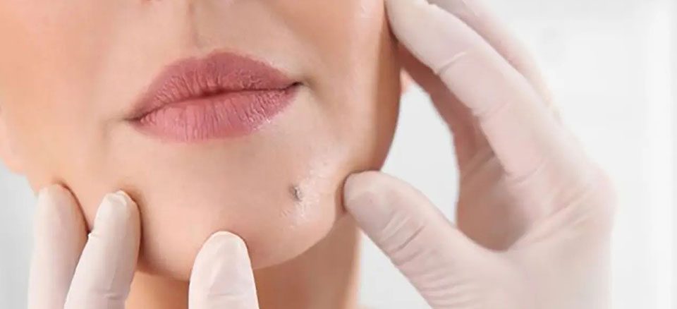 برداشتن خال لب چگونه انجام میشود؟ روشها، مزایا و مراقبتها - ویزیت منزل