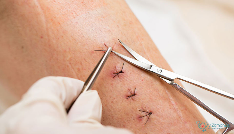 بعد از کشیدن بخیه چه پمادی بزنیم؟