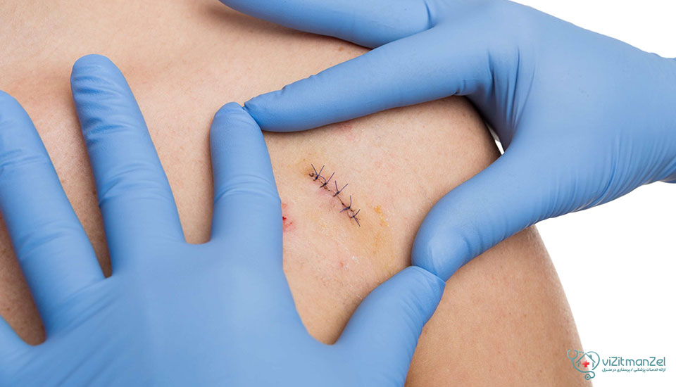 آیا کشیدن بخیه درد دارد؟ بررسی علتها، راهکارها و مراقبتها