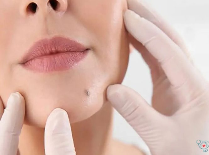 برداشتن خال لب چگونه انجام می‌شود؟ روش‌ها، مزایا و مراقبت‌ها