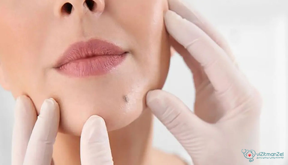 برداشتن خال لب چگونه انجام می‌شود؟ روش‌ها، مزایا و مراقبت‌ها