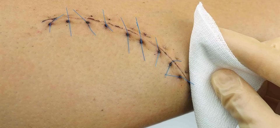 مراقبتهای بعد از بخیه زیبایی نقش مهمی در جلوگیری از عفونت و بهبود سریعتر دارد.