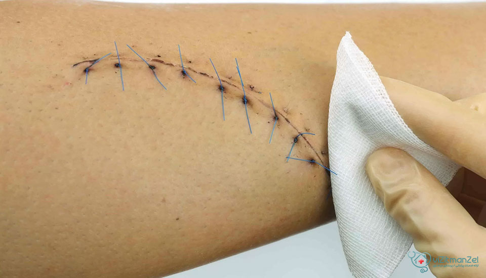 مراقبتهای بعد از بخیه زیبایی نقش مهمی در جلوگیری از عفونت و بهبود سریعتر دارد.