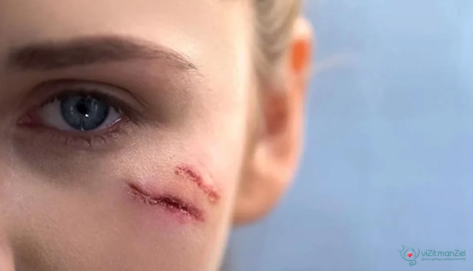 تفاوت بخیه زیبایی با چسب بخیه در دوام، دقت ترمیم و اثر نهایی روی پوست است.