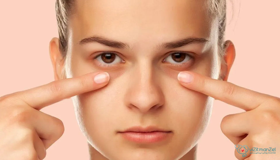 مراقبت‌های ضروری و مهم تزریق فیلر در زیر چشم