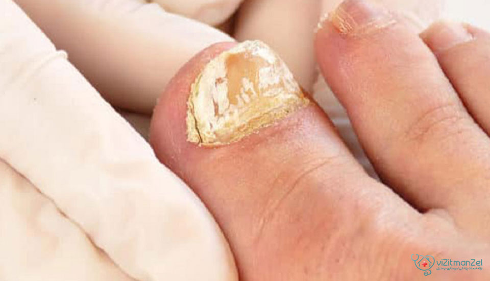 روش‌های پیشگیری از ابتلا به قارچ ناخن پا