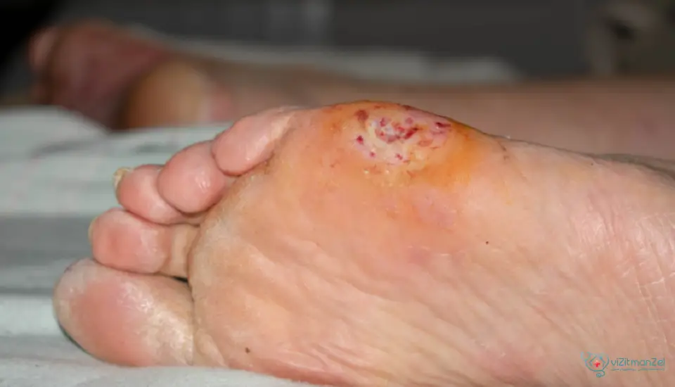زخم دیابتی چیست و چرا ایجاد می‌شود؟