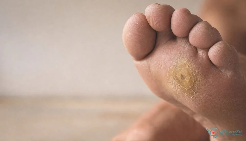 جلوگیری از ایجاد دوباره پینه پا